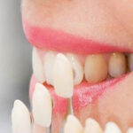 لمینیت دندان برای چه کسانی مناسب است